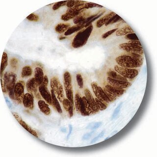 IHC of MLH1 on a Colon Carcinoma Tissue